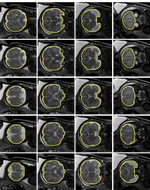 Automated Fetal Brain Segmentation Using Deep Convolutional Neural Network